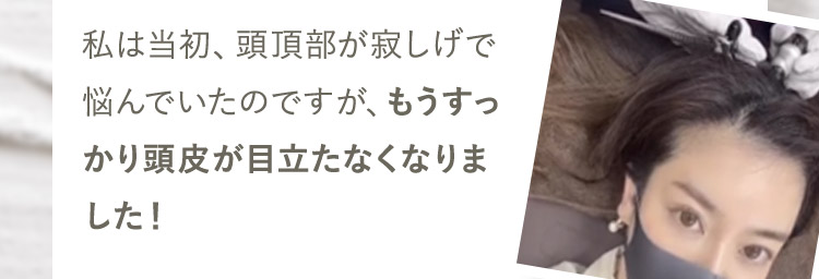 私は当初、頭頂部が寂しげで悩んでいたのですが、もうすっかり頭皮が目立たなくなりました!