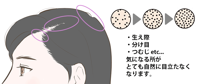 頭皮アートメイクのドットを表現した図
