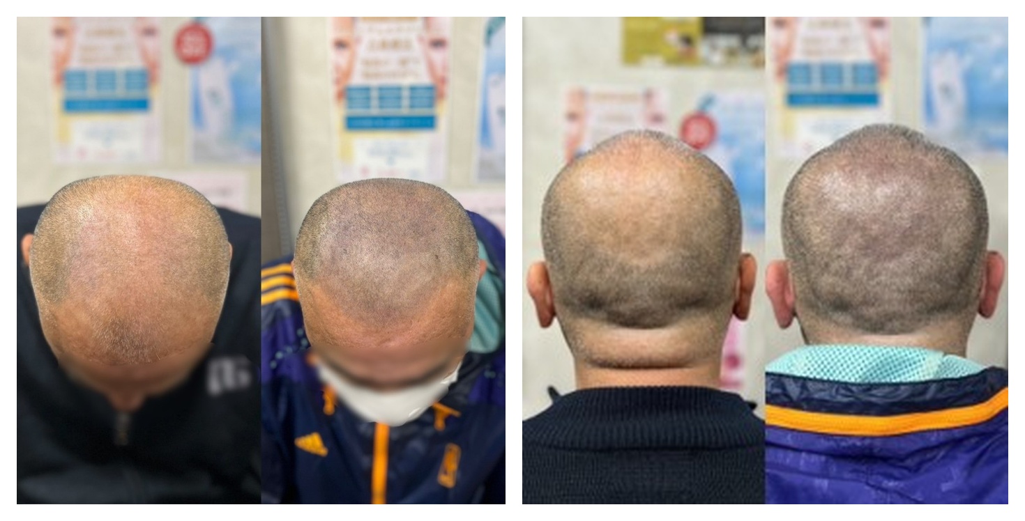 当院の頭皮アートメイク症例｜坊主男性の頭頂部・生え際・後頭部の施術前後比較