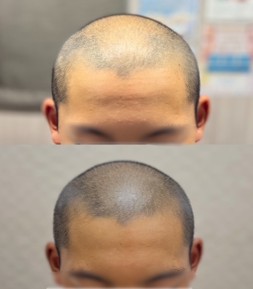 当院の頭皮アートメイク症例